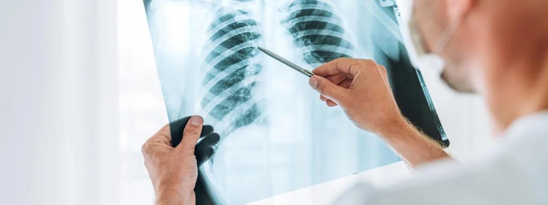 Inteligência artificial consegue prever risco de câncer de pulmão